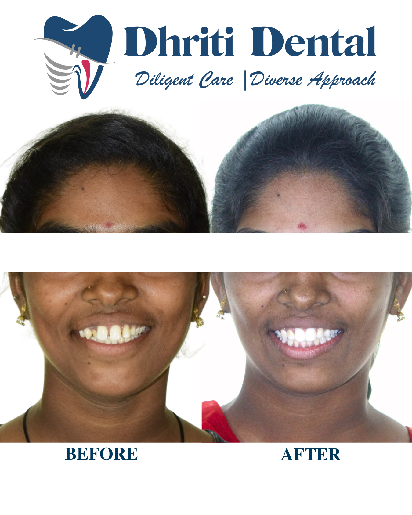 Braces Treatment